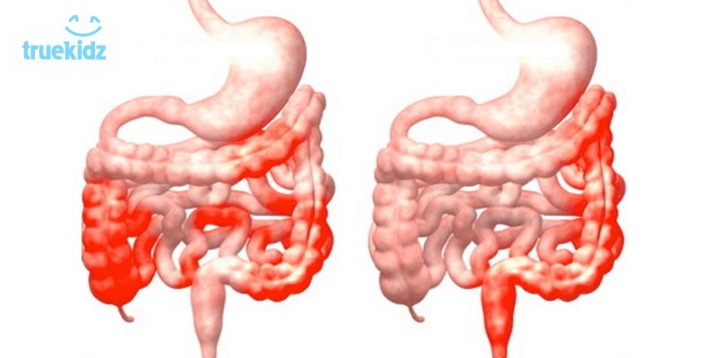 Tìm hiểu về bệnh Crohn