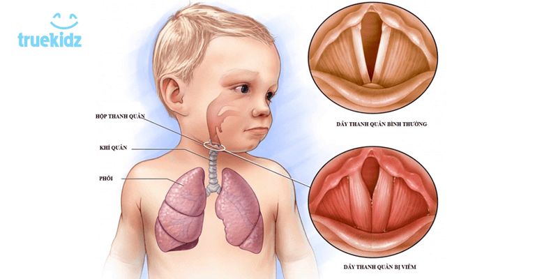 1001 điều cần biết về bệnh viêm phế quản ở trẻ em