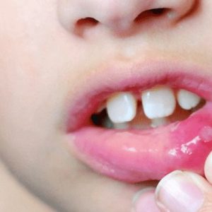 Nhiệt miệng ở trẻ em: Nguyên nhân và cách điều trị